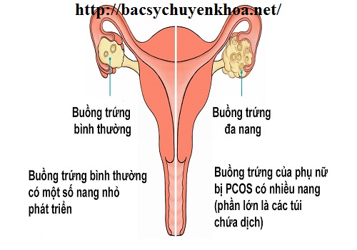 Bệnh đa nang buồng trứng có nguy hiểm không, có mang thai được không Bệnh đa nang buồng trứng có nguy hiểm không, có mang thai được không