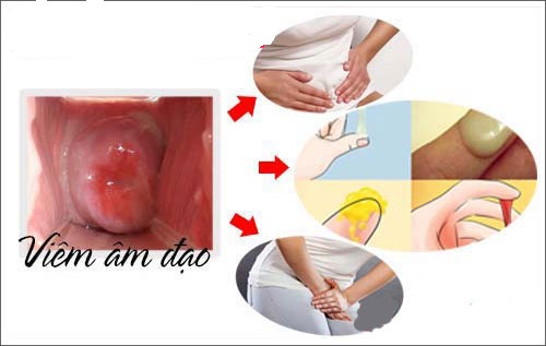 Triệu chứng viêm âm đạo