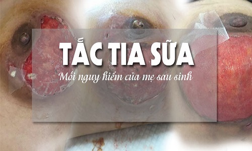 tac-tia-sua tắc tia sữa