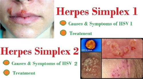 virus-gay-mun-rop-sinh-duc2 hinh-anh-mun-rop-sinh-duc
