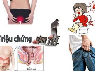 Nguyên nhân và cách điều trị bệnh trĩ