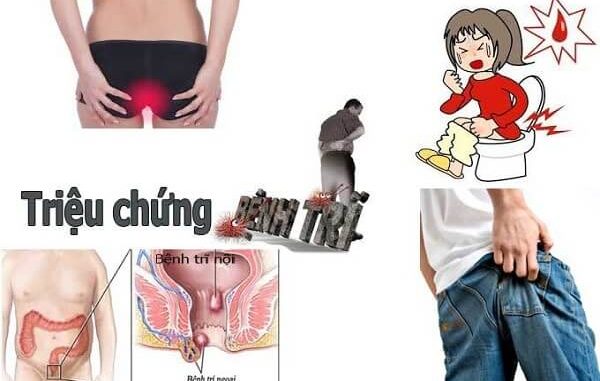 benh-tri Nguyên nhân và cách điều trị bệnh trĩ